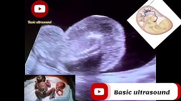 Acardiac twin*( TRAP)*