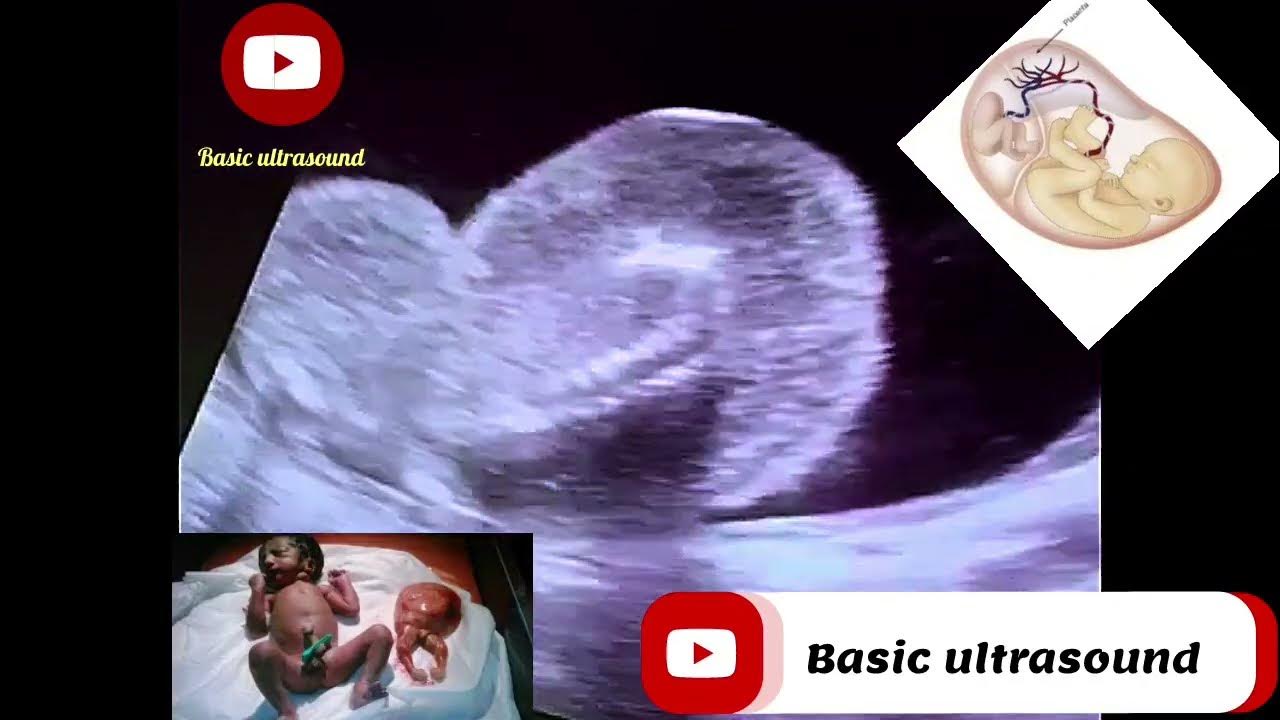 Acardiac twin*( TRAP)* YouTube