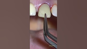 Socket-Shield technique implant placement and immediate loading. #dentaltreatment #implantdentistry