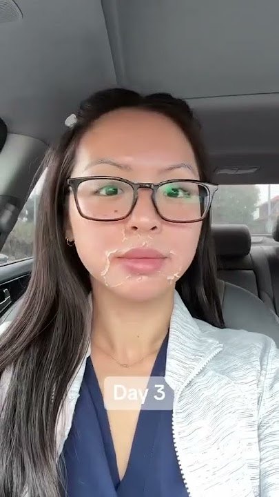 🌟 Get That Glow! Chemical Peel Before And After