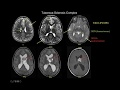 Pediatric neuroradiology lectures children with epilepsy