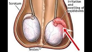 obat varikokel telur kemaluan bengkak sebelah