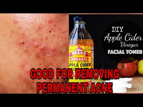 Apple Cider Vinegar Toner | Toner For Acne | Get Glowing Skin | Natural Toner