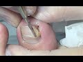 The sharp nail hurt the patient so much, we help to dig it out without feel(nice nail skill/method)