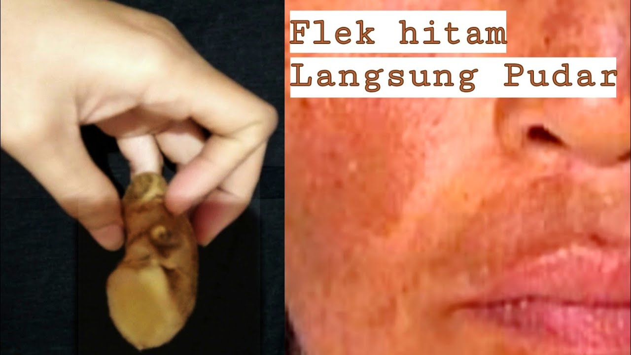 Sangat Manjur!! Cara menghilangkan flek hitam yang menahun ...