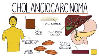 Understanding Cholangiocarcinoma