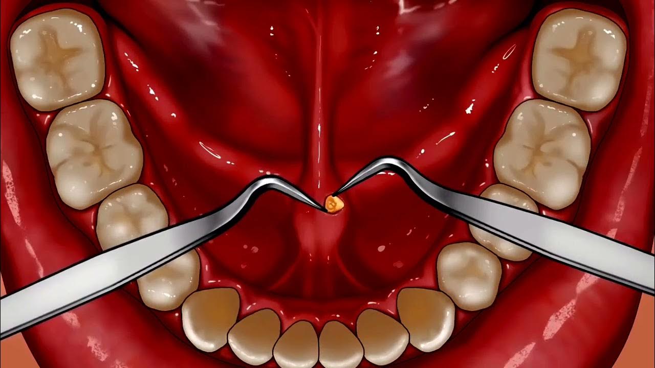 Asmr Salivary Gland Stones Removal Animation Youtube