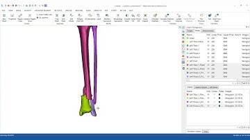 How to segment bones in MIS & prepare them for 3D printing?