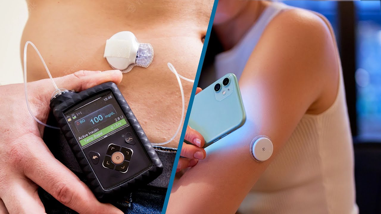 Continuous Glucose Monitor Vs Insulin Pump: Which Is More Effective?