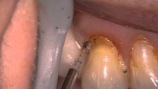 Thumbnail of Gingivectomy using Zolar Dental Diode Laser : By Dr. Glen Van As.