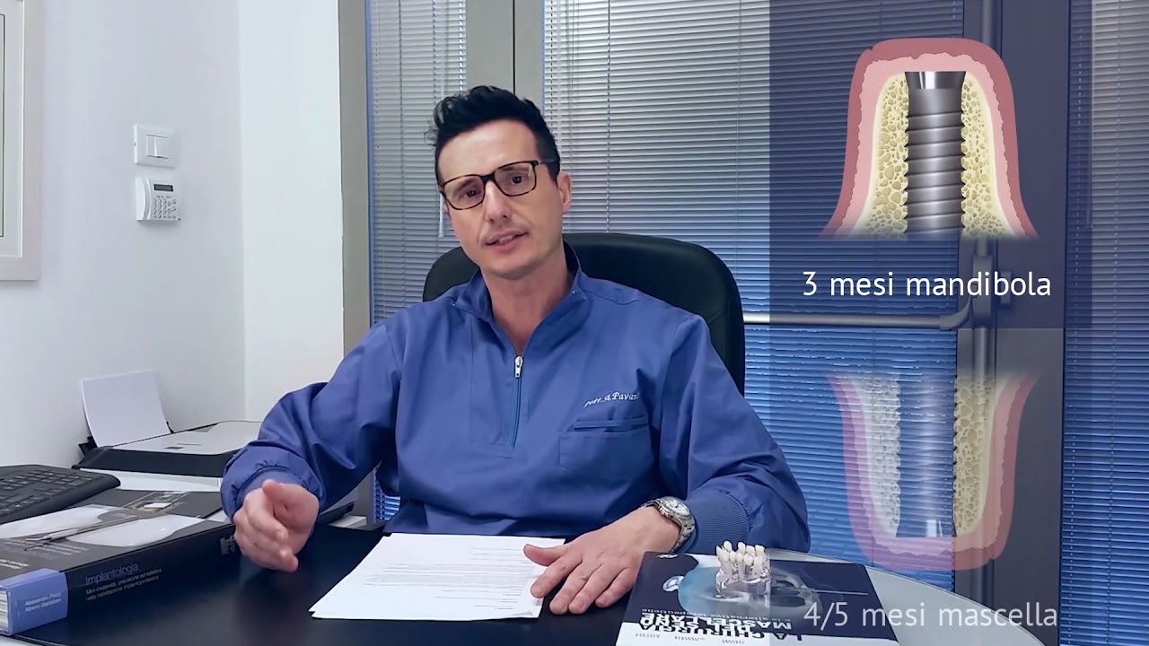 L'implantologia: le risposte alle domande più frequenti