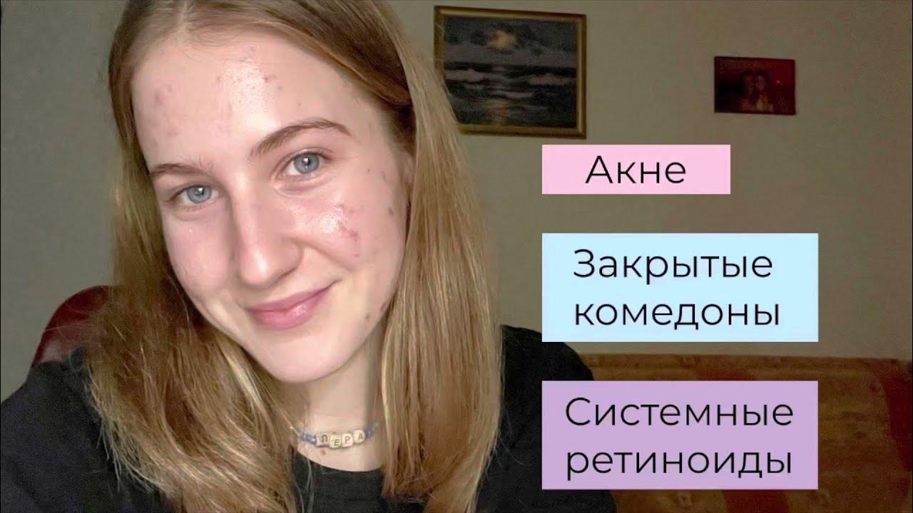 Лечение закрытых комедонов - YouTube