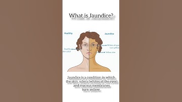 "Understanding Jaundice: Causes, Symptoms, and Treatment" @DrAshishSachan