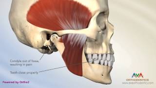 Sometimes heavy contacts between teeth cause tmj pain.