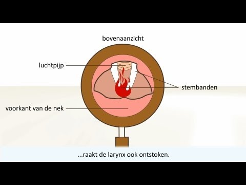 Keelontsteking - de oorzaak en behandeling