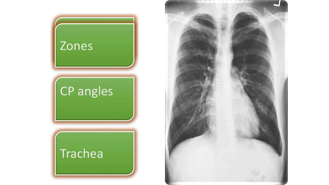 chest xray lecture 1 part 2 YouTube