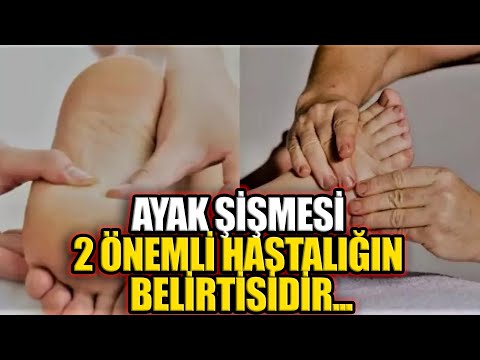 Ayak Şişmesi 2 Önemli Hastalığın Belirtisidir