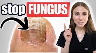 How to Treat and Prevent Toenail Fungus at Home (Step-by-Step)