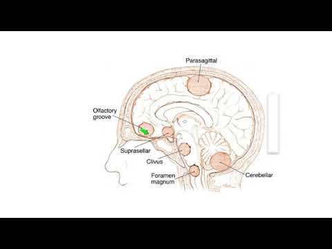 Meningiomas: Signs, Symptoms and Advanced Treatment Options