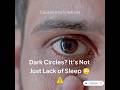 Under Eye Dark Circles = Hidden Health Problem?