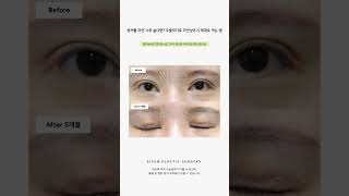 쌍꺼풀 라인 너무 높다면? 두줄따기로 라인낮추기 제대로 하는 법