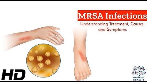 MRSA Unmasked: A Comprehensive Guide to Causes, Symptoms, and Treatment