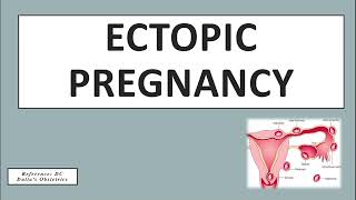 Ectopic Pregnancy | Obs & Gynae | Rapid Revision | DC Dutta screenshot 1