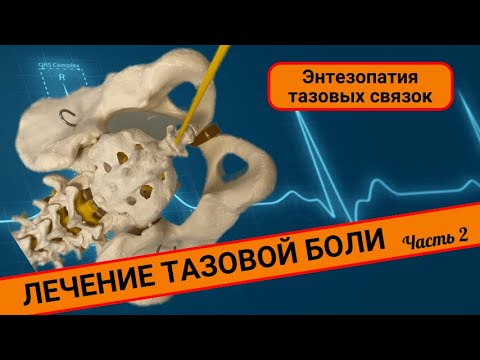 ТАЗОВАЯ БОЛЬ. ЛЕЧНИЕ.