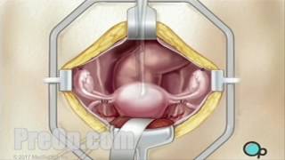 Hysterectomy Removal Of Uterus, Ovaries And Fallopian Tubes Surgery Preop Patien Education