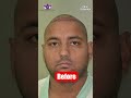 Hair Transplant Success Before And After Results 