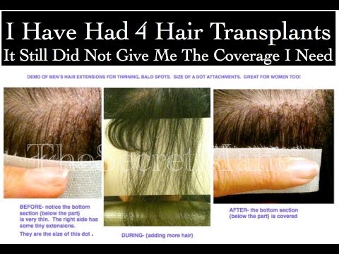 ▶ Men's Hair Extensions For Thinning, Balding. Enhances Post Hair Transplant Surgery.