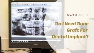 Do I Need Bone Graft for Dental Implant?