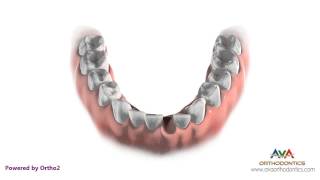 Celebrity Orthodontic Treatment for Severe Crowding - Removing 1 Lower Front Tooth Wealth