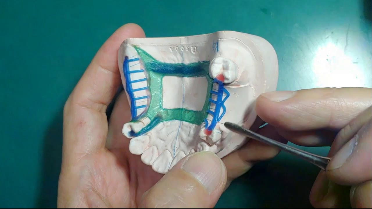 上, A-P bar Wax upㆍ115(YG Dental Lab)