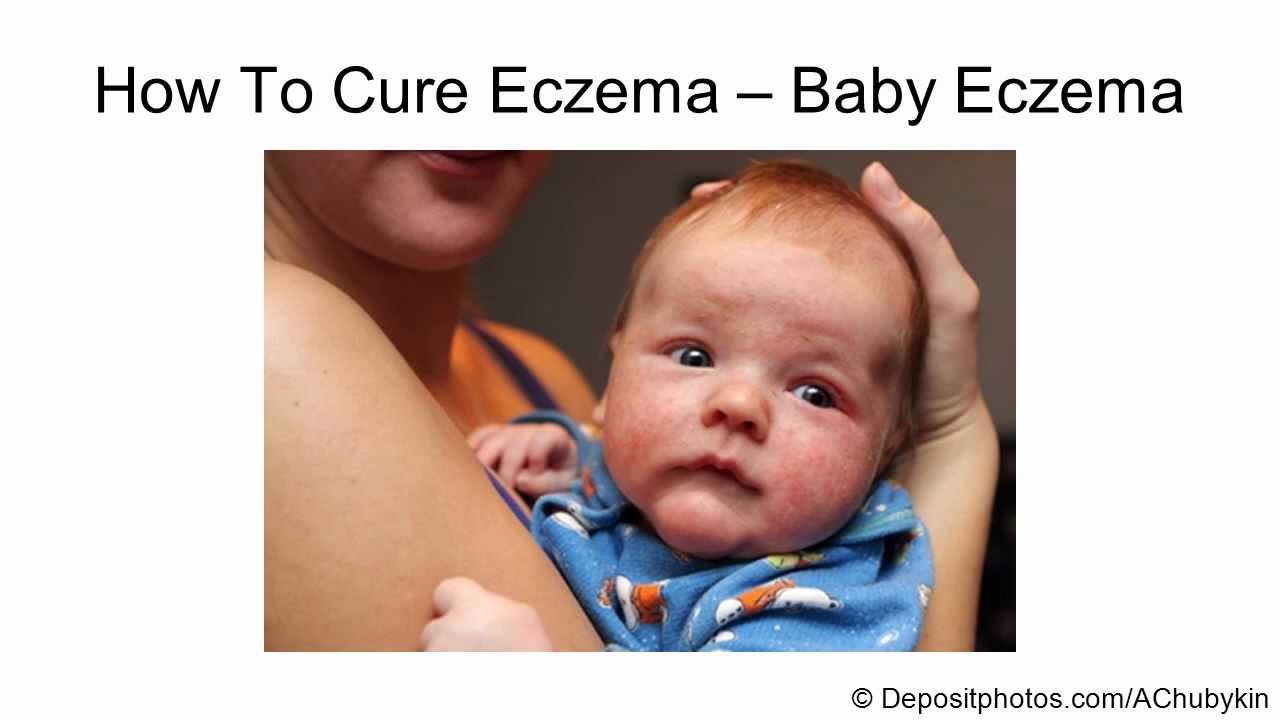 How to cure baby eczema cure for baby eczema YouTube