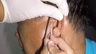 Man's Ear Gets Cleaned by Using A Cotton Pledget