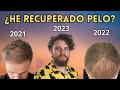 ¿HE RECUPERADO MI PELO TRASPLANTADO?