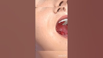 Adenoidectomy explained (3D Animation)