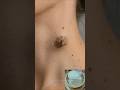 Remove Skin Tag Naturally At Home | Skin Tag & Wart Removal Easy Remedy #tags #skincare #shorts