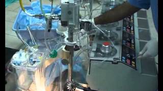 Heart Lung Machine (Setting up the extracorporeal circulation)