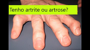 Como tratar artrose nos dedos?