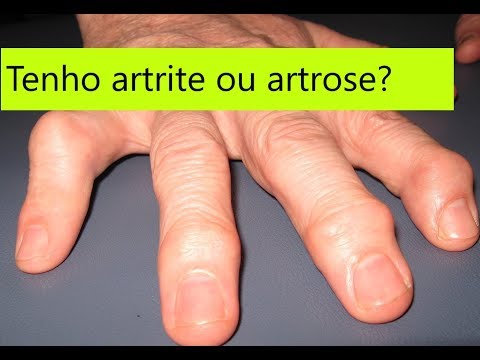 Vídeo: Artrite Nos Dedos E Articulações: Fotos, 8 Sintomas E Muito Mais