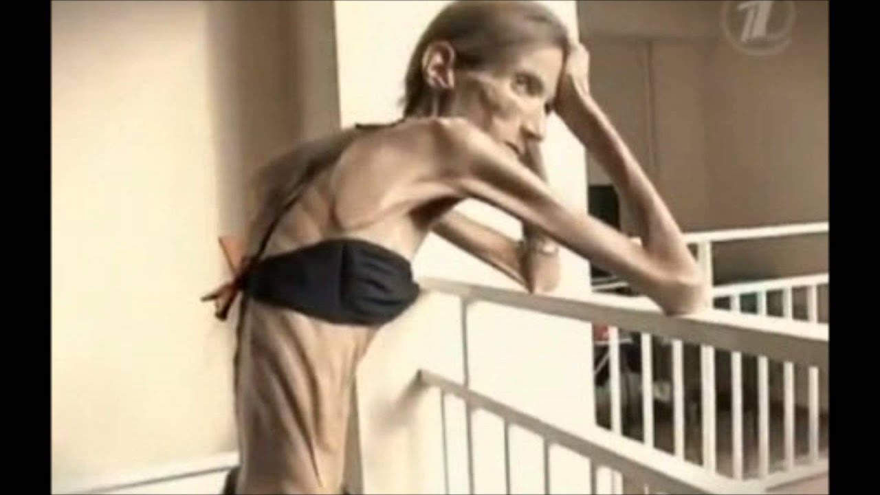 The Most Anorexic Woman In The World! 