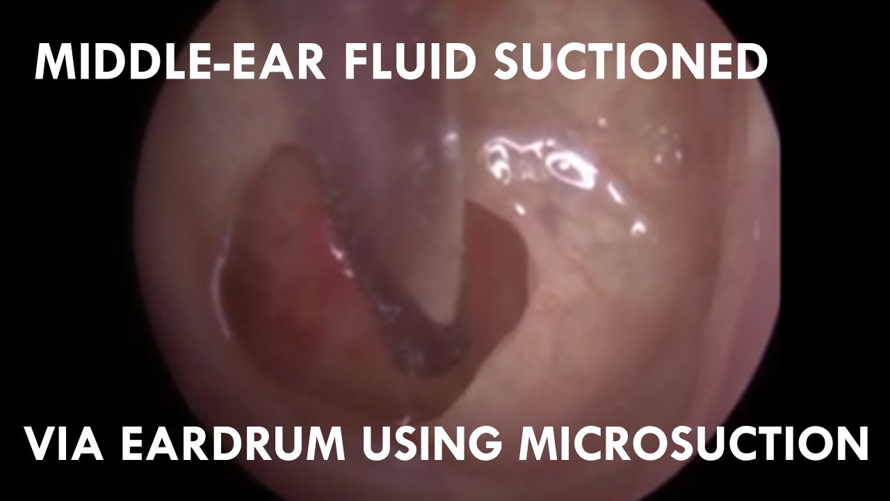 SQUIRTING MIDDLE-EAR FLUID MICROSUCTIONED FROM CHRONIC SUFFERER !! - #458