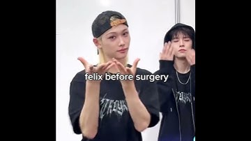 felix before and after surgery #kpop #straykids #felix #viral #shorts #fyp