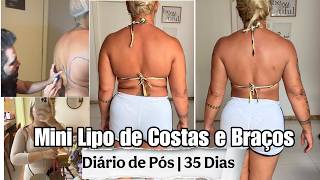 DIÁRIO DA MINI-LIPO NAS COSTAS E BRAÇOS | 35 DIAS