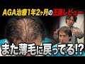 【30歳薄毛】治療薬を1年2ヶ月飲み続けたリアルな状態がヤバい...!
