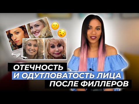 Филлеры гиалуроновой кислоты не рассасываются? Откуда берутся отёчные гиалуроновые лица наших звёзд?