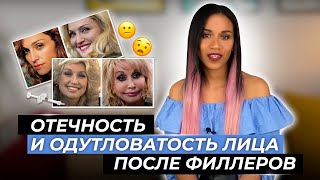 Филлеры гиалуроновой кислоты не рассасываются? Откуда берутся отёчные гиалуроновые лица наших звёзд?