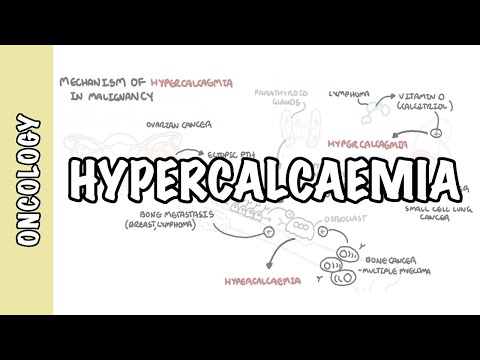 Hypercalcemia in malignancy - causes, pathophysiology, symptoms, treatment